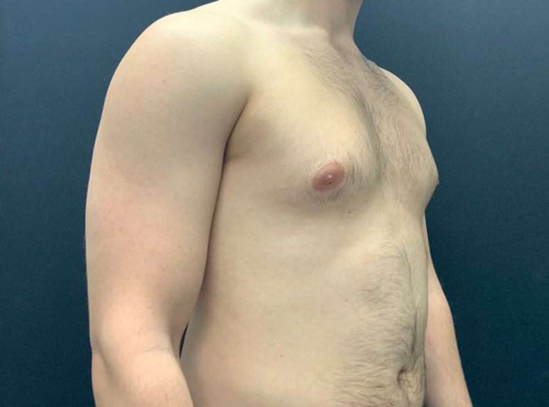 24 year old male shown 3 months after excision of bilateral gynecomastia and chest liposuction