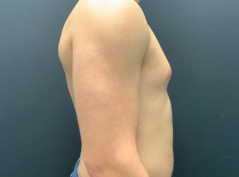 24 year old male shown 3 months after excision of bilateral gynecomastia and chest liposuction