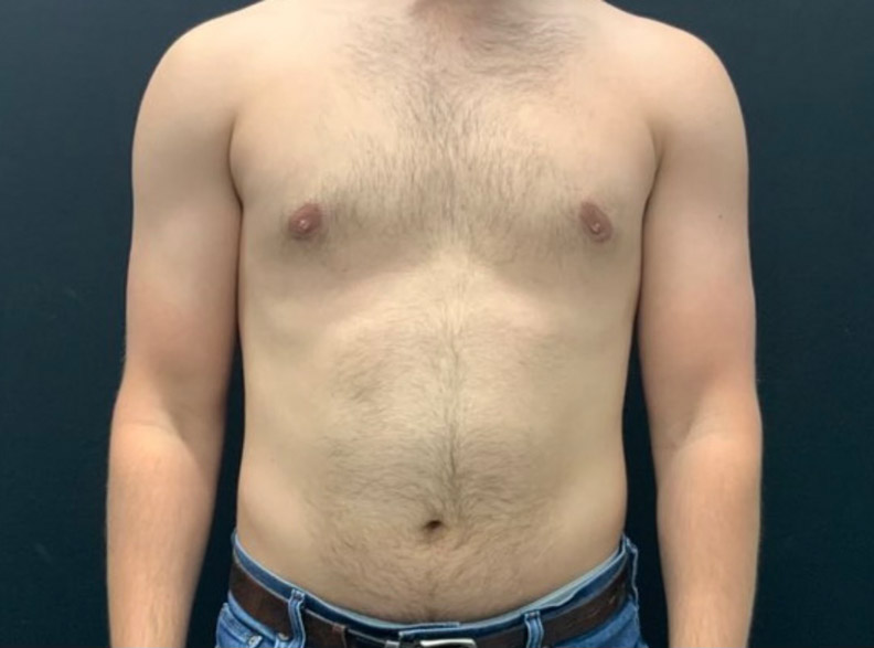 24 year old male shown 3 months after excision of bilateral gynecomastia and chest liposuction