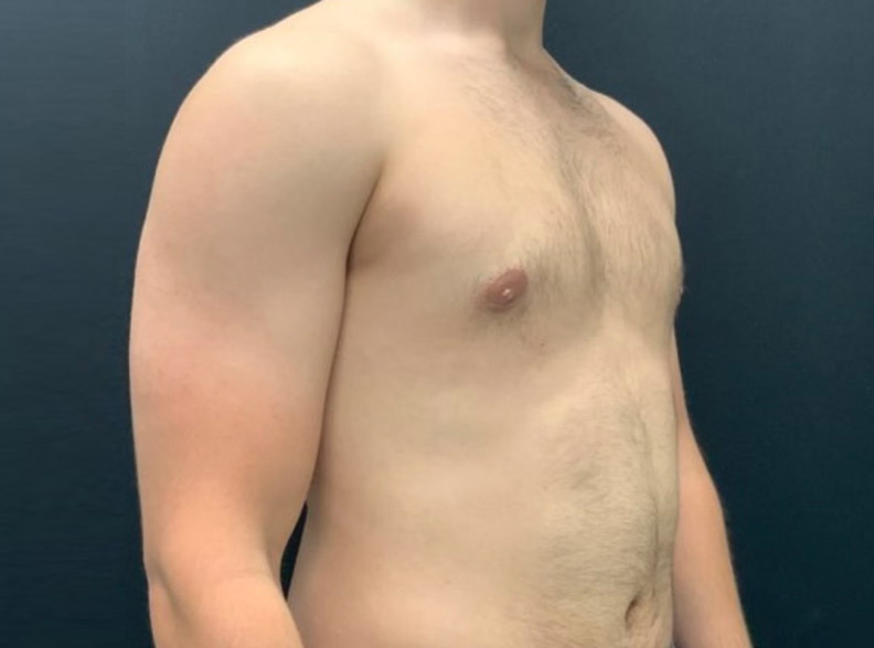 24 year old male shown 3 months after excision of bilateral gynecomastia and chest liposuction