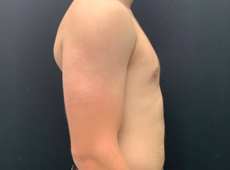 24 year old male shown 3 months after excision of bilateral gynecomastia and chest liposuction