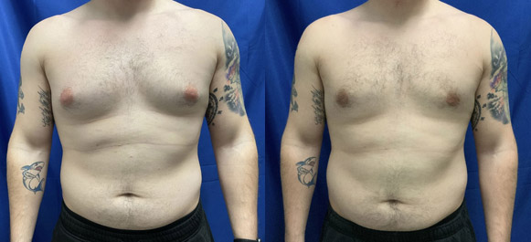 gynecomastia