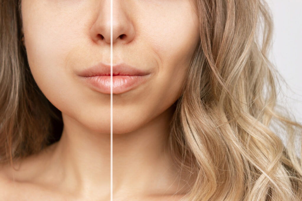 Featured image for How Long Do Buccal Fat Removal Results Last?