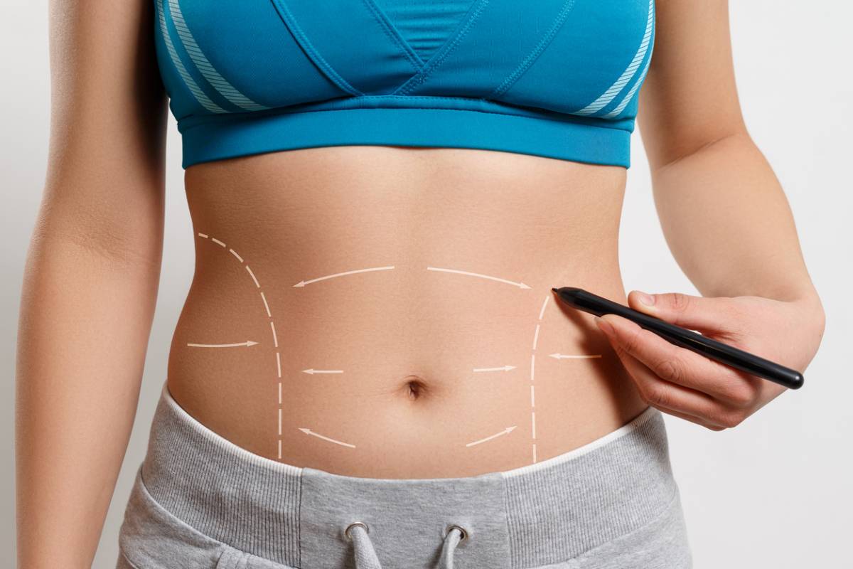 featured image for how to improve tummy tuck results