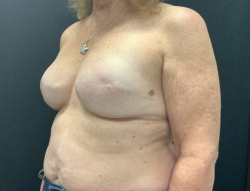 Woman in her 60s 3 months after bilateral breast reconstruction with implant repositioning to prepectoral pocket and alloderm placement.