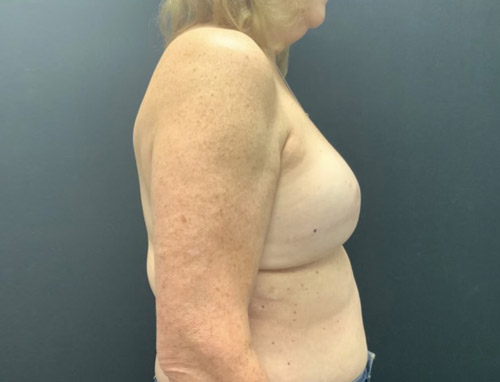 Woman in her 60s 3 months after bilateral breast reconstruction with implant repositioning to prepectoral pocket and alloderm placement.