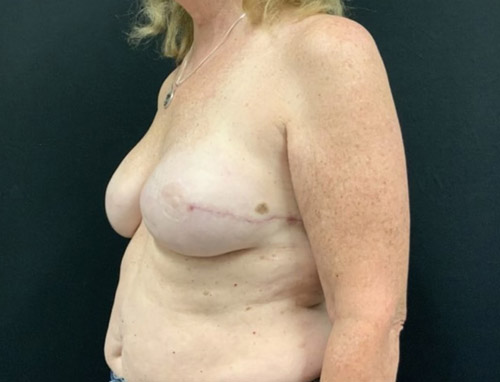 Woman in her 60s 3 months after bilateral breast reconstruction with implant repositioning to prepectoral pocket and alloderm placement.