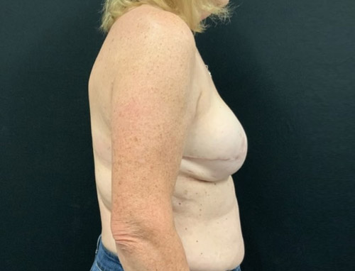 Woman in her 60s 3 months after bilateral breast reconstruction with implant repositioning to prepectoral pocket and alloderm placement.