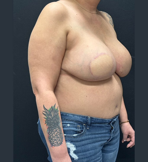 43-years-old patient is shown about 8 months after double mastectomy and reconstruction with bilateral DIEP flaps