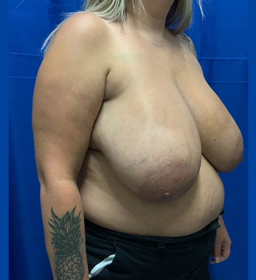 43-years-old patient is shown about 8 months after double mastectomy and reconstruction with bilateral DIEP flaps