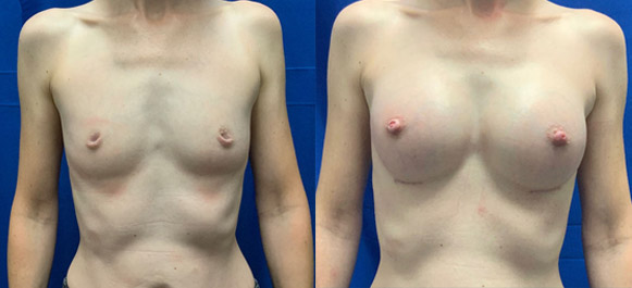 inverted-nipple-correction-image