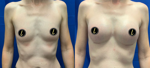 inverted nipple correction image