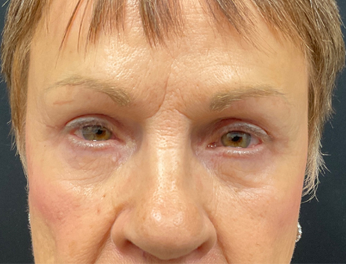 3 months Before and After Brow Lift, Upper blepharoplasty, and Ptosis repair