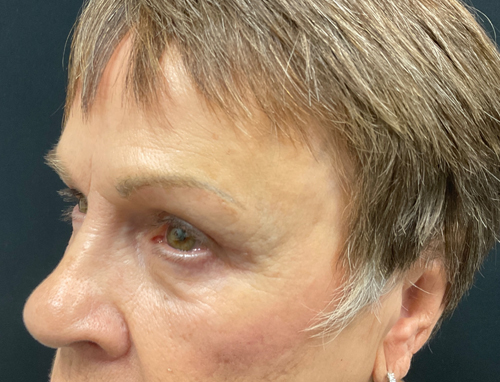 3 months Before and After Brow Lift, Upper blepharoplasty, and Ptosis repair
