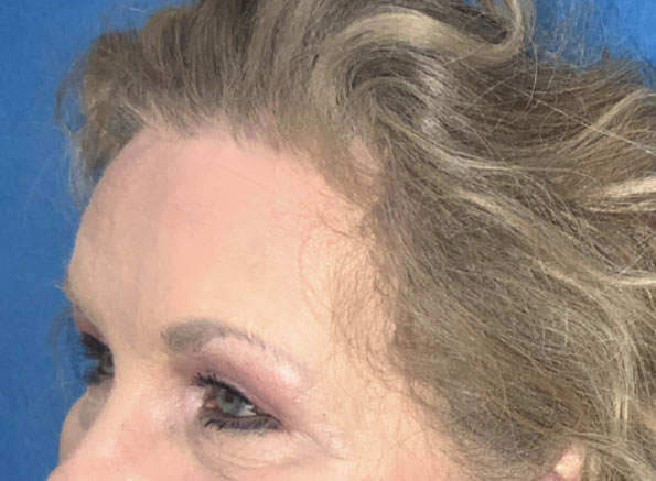 3 months before and after upper blepharoplasty and endoscopic brow lift