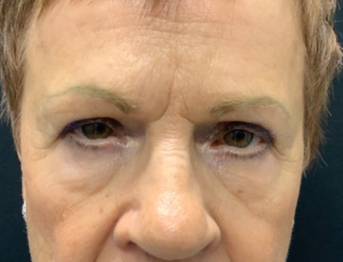 3 months Before and After Brow Lift, Upper blepharoplasty, and Ptosis repair