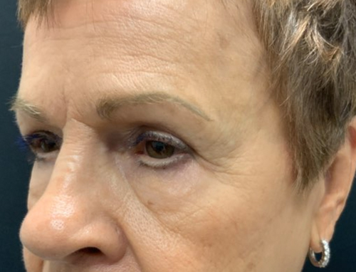 3 months Before and After Brow Lift, Upper blepharoplasty, and Ptosis repair