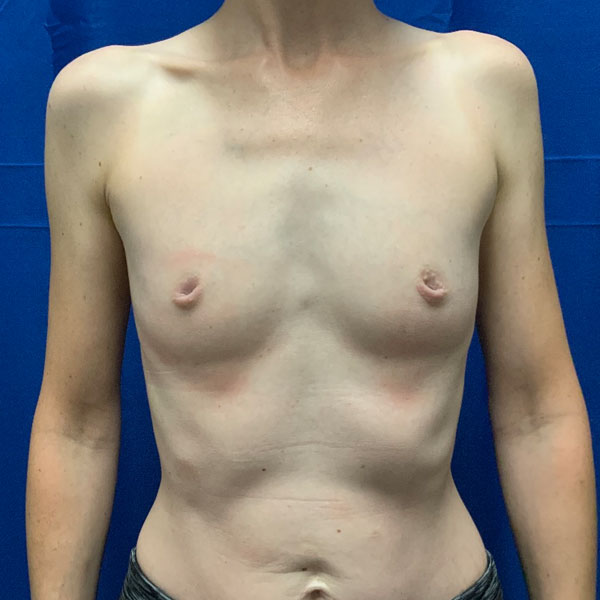 This is a young woman in her late 30s shown 3 months after bilateral breast augmentation with smooth round moderate profile Sientra gel Implants and correction of inverted nipple deformity