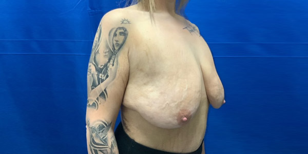 Mastopexy and augmentation angle before Mastopexy and augmentation angle before
