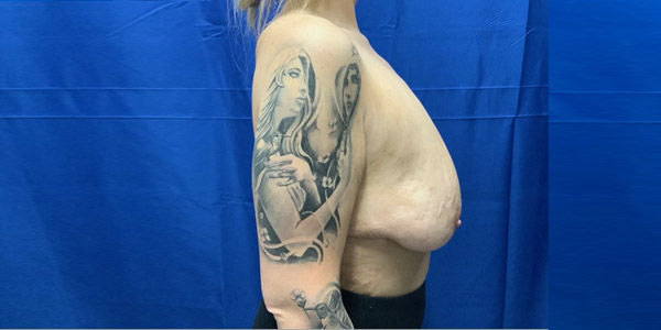 Mastopexy and augmentation side before Mastopexy and augmentation side before