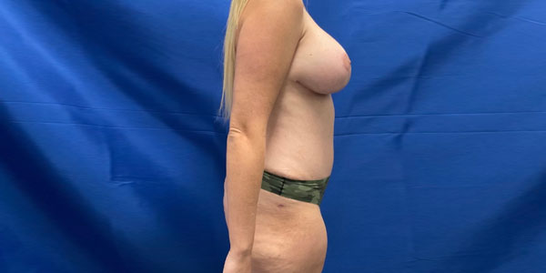 In addition to full abdominoplasty patient underwent bilateral mastopexy and augmentation with 340 cc smooth round moderate profile boost mentor gel implants. To refine her abdominal and thigh contour we performed liposuction of those areas as well