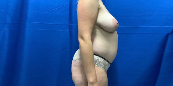 In addition to full abdominoplasty patient underwent bilateral mastopexy and augmentation with 340 cc smooth round moderate profile boost mentor gel implants. To refine her abdominal and thigh contour we performed liposuction of those areas as well