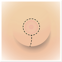 TYPES OF BREAST LIFT