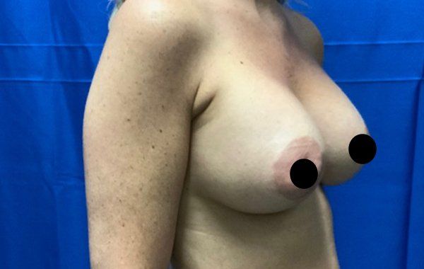 38 year old female 6 weeks after bilateral dual plane breast augmentation with 325 cc Sientra Moderate Plus Profile Smooth round breast implants side view2