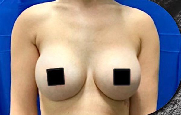 After Breast Augmentation procedure After Breast Augmentation procedure