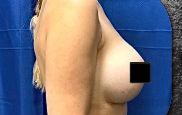 Before Breast Augmentation procedure Side view2