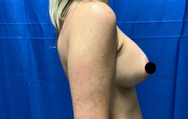 38 year old female 6 weeks after bilateral dual plane breast augmentation with 325 cc Sientra Moderate Plus Profile Smooth round breast implants side view