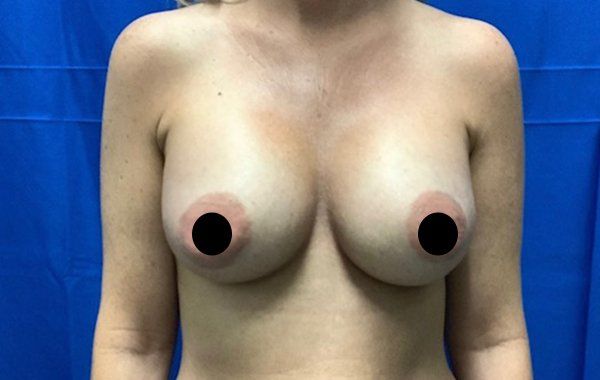 38 year old female 6 weeks after bilateral dual plane breast augmentation with 325 cc Sientra Moderate Plus Profile Smooth round breast implants