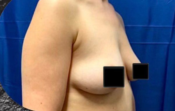 Before Breast Augmentation procedure Side view