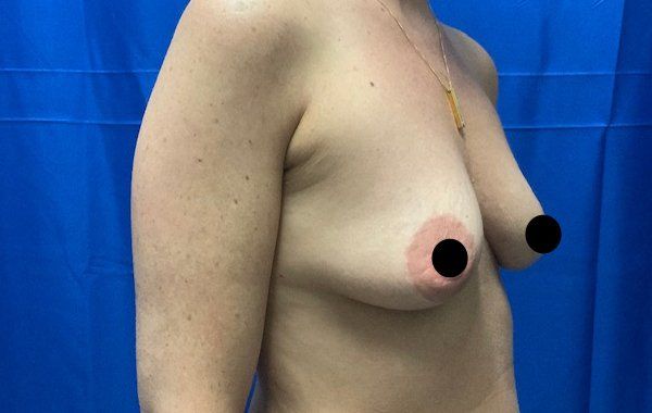 38 year old female 6 weeks before bilateral dual plane breast augmentation with 325 cc Sientra Moderate Plus Profile Smooth round breast implants side view2
