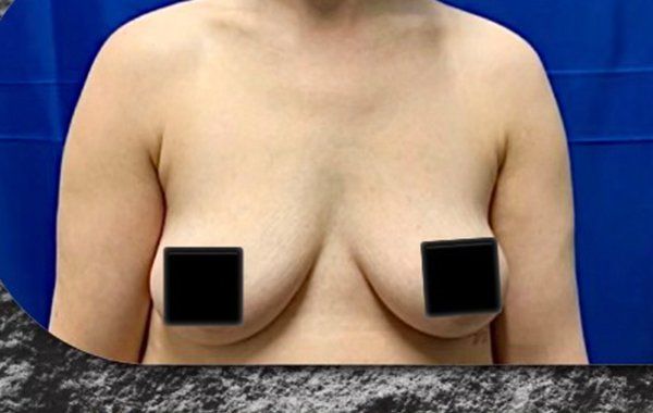 Before Breast Augmentation procedure Before Breast Augmentation procedure