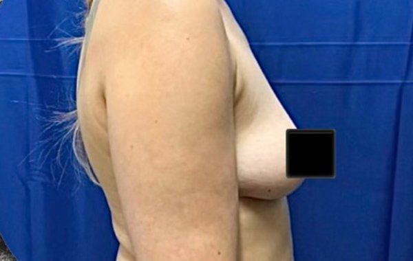 Before Breast Augmentation procedure Side view2 Before Breast Augmentation procedure Side view2