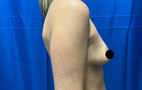 38 year old female 6 weeks before bilateral dual plane breast augmentation with 325 cc Sientra Moderate Plus Profile Smooth round breast implants side view