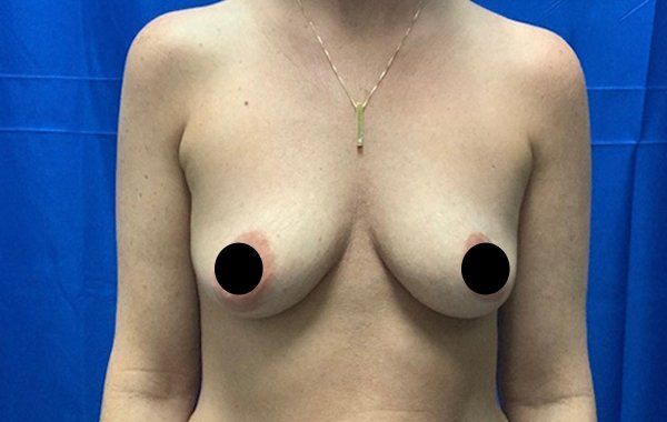 38 year old female 6 weeks before bilateral dual plane breast augmentation with 325 cc Sientra Moderate Plus Profile Smooth round breast implants