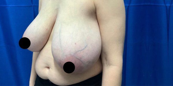 Breast Reduction angle before Breast Reduction angle before