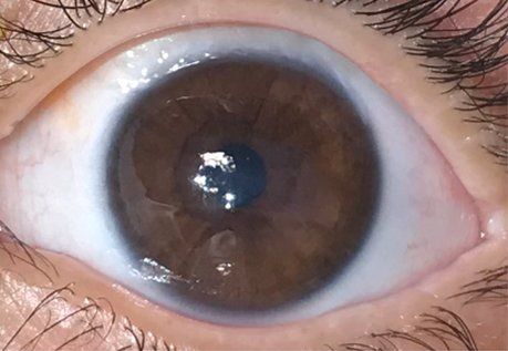 Patient1 corneal neurotization after