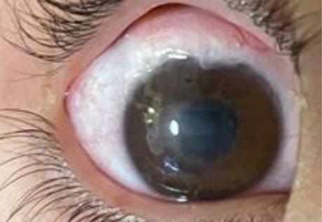 Patient2 corneal neurotization after