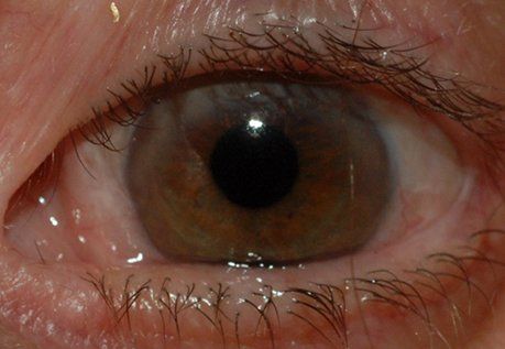 Patient3 corneal neurotization after