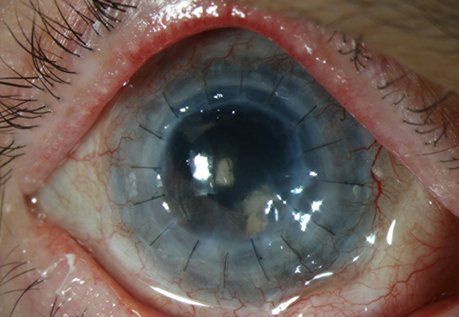 Patient4 corneal neurotization after