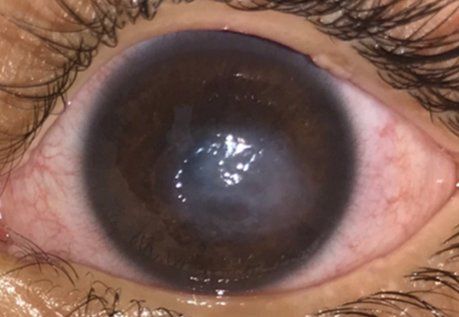 Patient1 corneal neurotization before