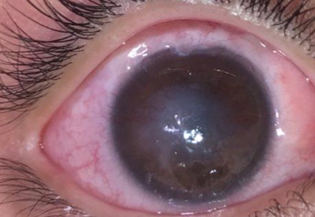 Patient2 corneal neurotization before