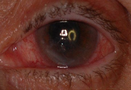 Patient3 corneal neurotization before