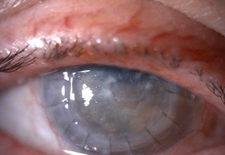 Patient4 corneal neurotization before