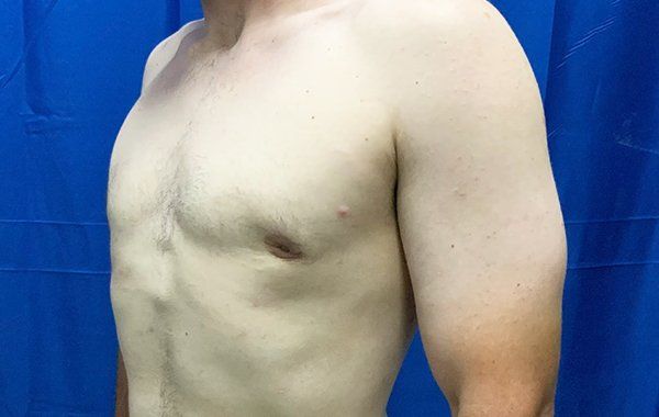 Patient1 Gynecomastia angle after