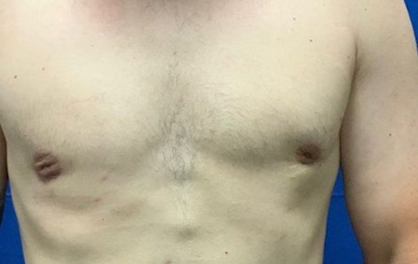 Patient1 Gynecomastia front after