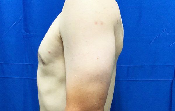 Patient1 Gynecomastia side after